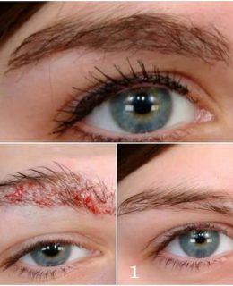 کاشت ابرو؛ راه‌حل نهایی برای داشتن ابروهای پرپشت و طبیعی