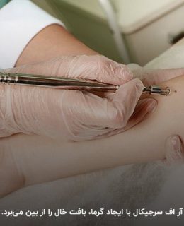 آر اف سرجری تحولی در درمان ضایعات پوستی