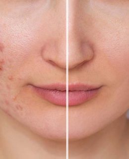 سابسیژن چیست؟