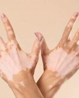 درباره ویتیلیگو (لک و پیس یا برث) چه می‌دانید؟